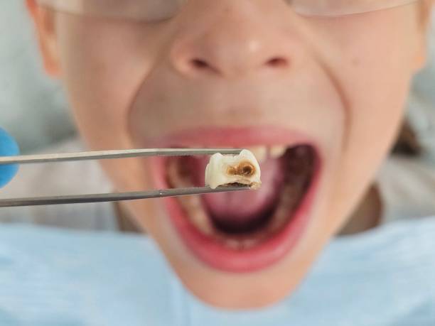 Best Emergency Wisdom Teeth Removal in La Crosse, WI